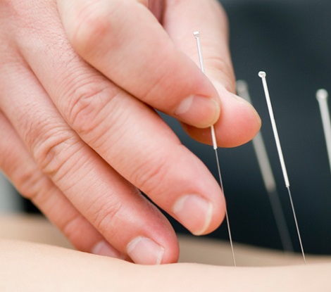 Acupuncture For Pain