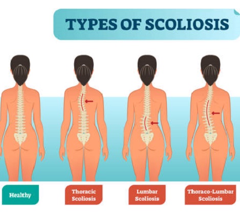 Scoliosis