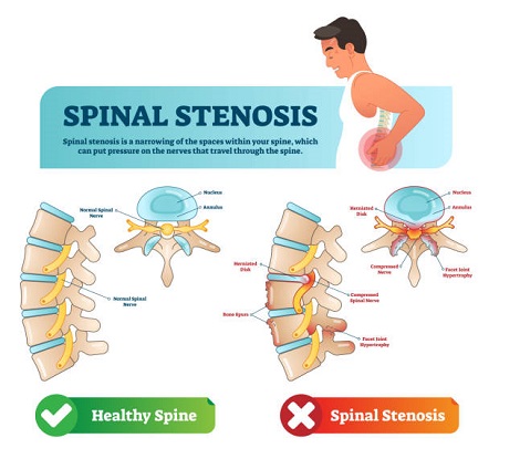 Spinal Stenosis