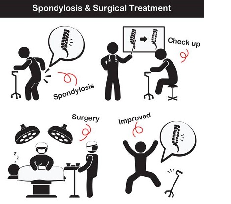 Spondylosis