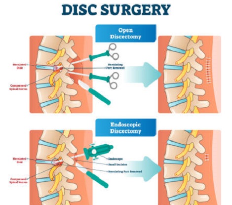 Lumbar Discectomy