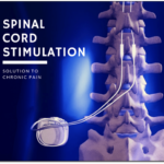 Effectiveness of Spinal Cord Stimulation