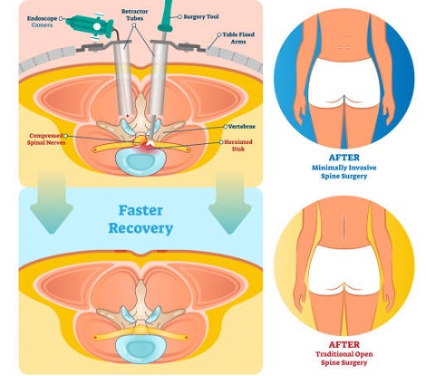 Minimally Invasive Spine Surgery